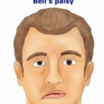 bells-palsy-rehabilitation-rohtak