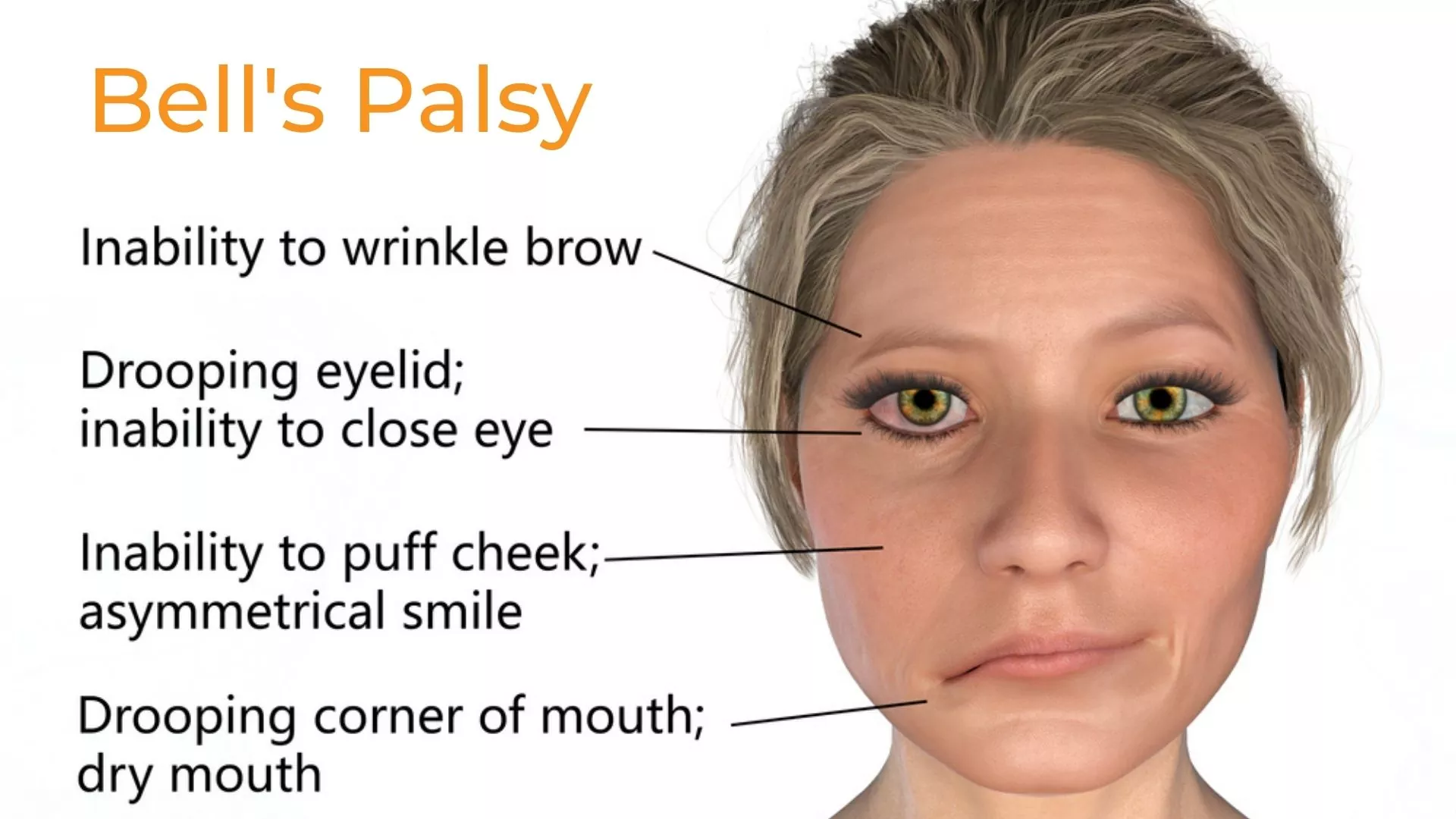 Patient receiving Bell's Palsy Treatment in Rohtak