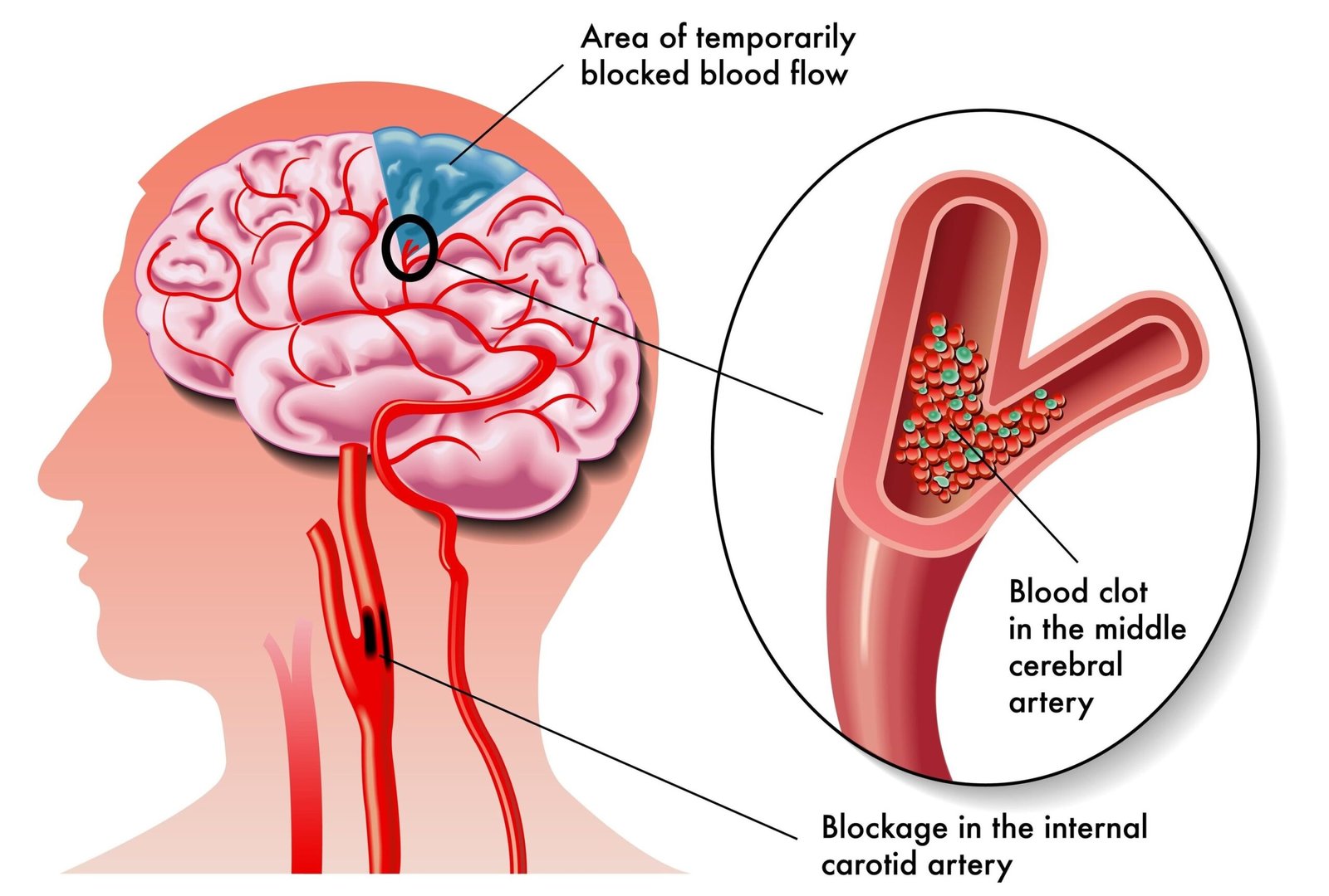 Patient undergoing Stroke Rehabilitation in Rohtak session