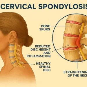 Cervical Spondylosis Treatment