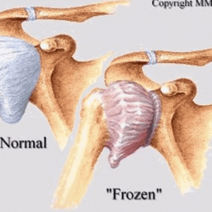 Frozen Shoulder Treatment