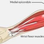 golfers-elbow-physiotherapy-rohtak