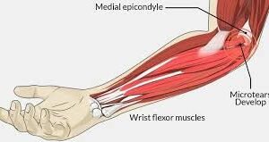 Golfers Elbow Physiotherapy