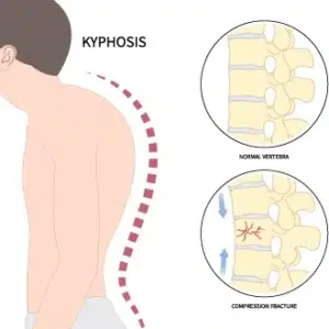 Kyphosis Physiotherapy Treatment