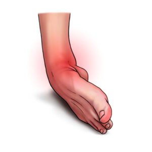 Ligament Sprain Physiotherapy 2