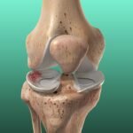 meniscus-injury-physiotherapy-rohtak