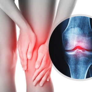 Osteoarthritis Physiotherapy Treatment