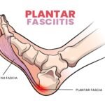 plantar-fasciitis-physiotherapy-rohtak