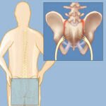 sacroiliac-joint-dysfunction-physiotherapy-rohtak