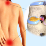 sciatica-and-slip-disc-treatment-rohtak