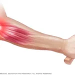 tennis-elbow-physiotherapy-rohtak