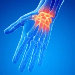wrist-pain-physiotherapy-rohtak